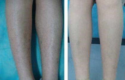 怎樣去除腿毛、*果怎么樣