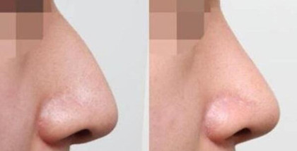 鷹鉤鼻整形要多少錢