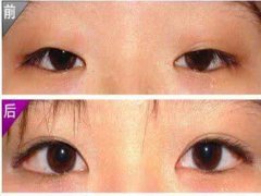 做開眼角的費(fèi)用