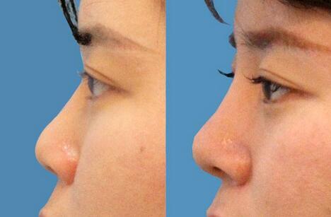 朝天鼻如何矯正 朝天鼻矯正術(shù)前術(shù)后注意事項