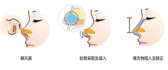 朝天鼻如何矯正 朝天鼻矯正術(shù)前術(shù)后注意事項(xiàng)