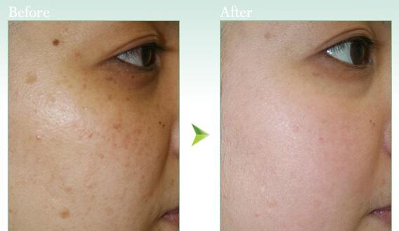 去除黃褐斑的價(jià)格一般是多少