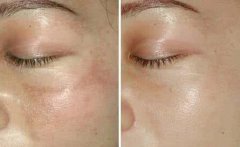 去除黃褐斑的價格一般是多少