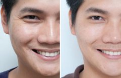 用什么方法能去皺、除皺多少錢