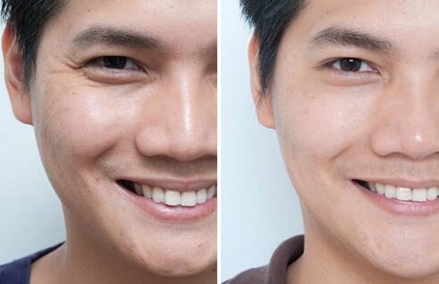 用什么方法能去皺、除皺多少錢