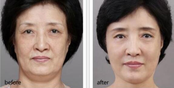 *,去皺,多少錢,注意事項