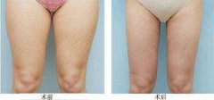 大腿抽脂多久恢復(fù)正常不痛，多久見？