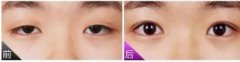 上瞼提肌手術(shù)有必要嗎？不做有什么危害？