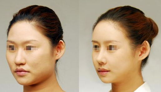 膨體隆鼻可以*嗎？有哪些注意事項？