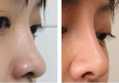 隆鼻后多久山根會(huì)自然？*果能保持多久？