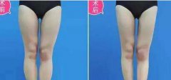 大腿吸脂后多久開始瘦？多久恢復(fù)？