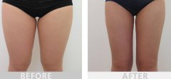 大腿吸脂3500能瘦多少？多久開始瘦？