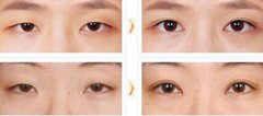 開眼角需要多少錢？能讓眼睛變大嗎？