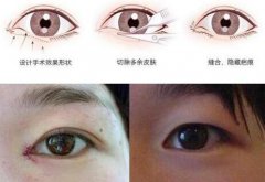 開(kāi)眼角手術(shù)一定會(huì)增生嗎