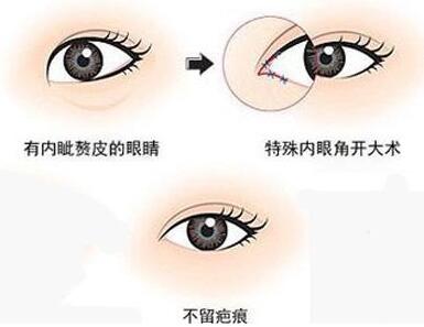 韓式*開(kāi)眼角價(jià)格