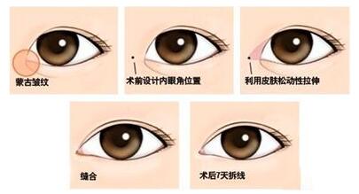 開眼角手術(shù)風(fēng)險大嗎