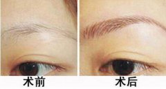 種植眉毛是怎么回事？種植眉毛有什么作用？