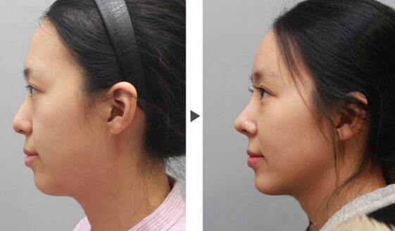 隆鼻術(shù)前注意，術(shù)前準備有哪些