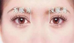 開眼角恢復(fù)時間要多久？多久恢復(fù)自然？