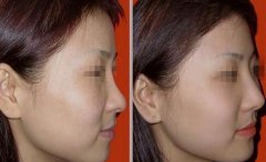 隆鼻以后怎么恢復(fù)快，術(shù)后如何護(hù)理?