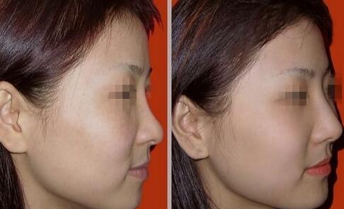 隆鼻以后怎么恢復(fù)快，術(shù)后如何護(hù)理?