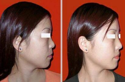 隆鼻以后怎么恢復(fù)快，術(shù)后如何護(hù)理?