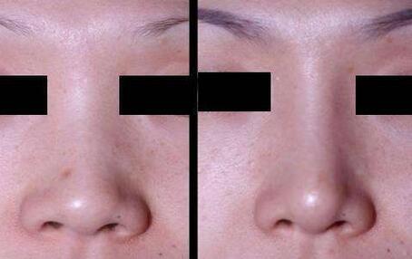 隆鼻手術(shù)恢復(fù)要多久，幾天恢復(fù)自然?