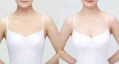 假體豐胸術(shù)后恢復(fù)注意事項(xiàng)？假體豐胸后需要注意哪些？