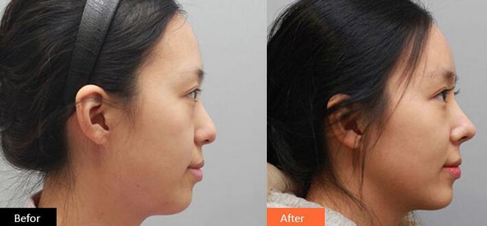 隆鼻多久消腫自然，術(shù)后多久能恢復(fù)？