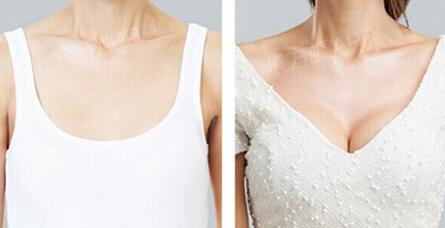 假體豐胸多久就不痛了，假體豐胸多久能恢復？