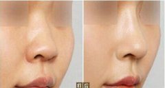 九院隆鼻多少錢？九院隆鼻醫(yī)生？