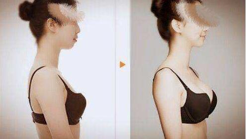 娜琦麗,假體隆胸,多少錢(qián),多久變軟