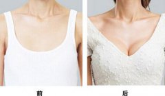 假體豐胸能保持多久，假體豐胸果可以維持多久？