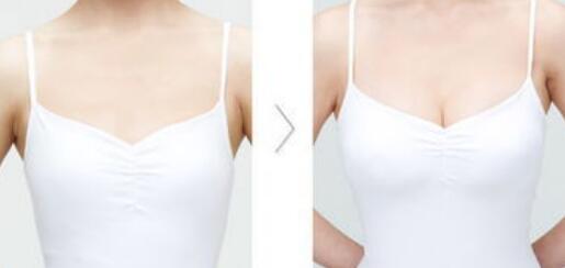 假體豐胸危害有哪些？假體豐胸有副作用嗎？