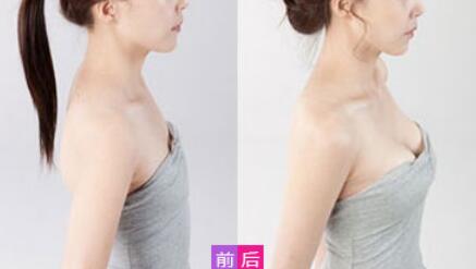 威寧假體豐胸怎么樣？威寧假體豐胸*果如何？