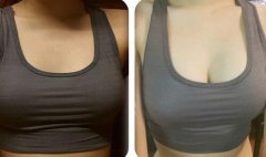 假體豐胸信息介紹？如何選醫(yī)院？