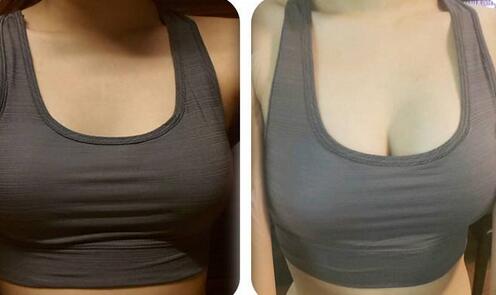 假體豐胸信息介紹？如何選醫(yī)院？