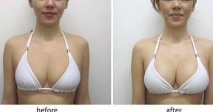 假體豐胸材料哪些好？假體豐胸*果圖