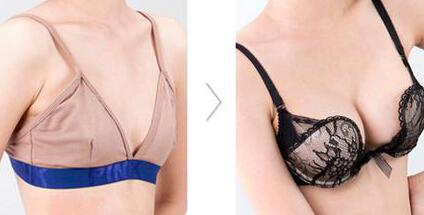 假體豐胸材料哪些好？假體豐胸*果圖