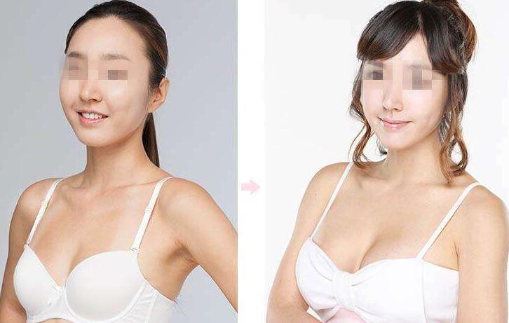 上海,假體豐胸手術(shù),多少錢,價格