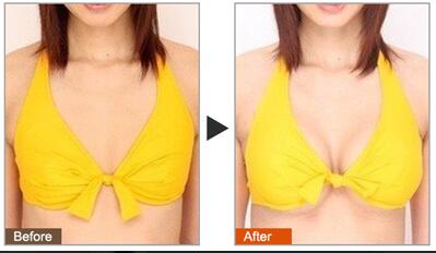 假體豐胸好的醫(yī)院有哪些？假體豐胸介紹？