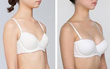 假體豐胸好的醫(yī)院有哪些？假體豐胸介紹？