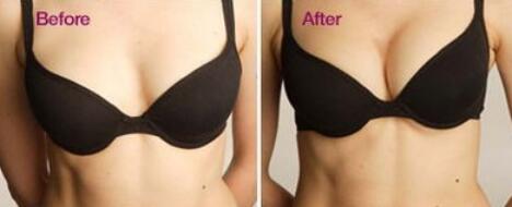 假體豐胸的副作用有哪些？假體豐胸*嗎？