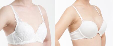 假體豐胸進(jìn)口材料有哪些?豐胸假體材料如何選擇？