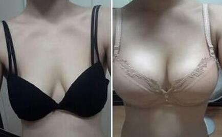 上海假體豐胸費用、上海假體豐胸手術(shù)多少錢？