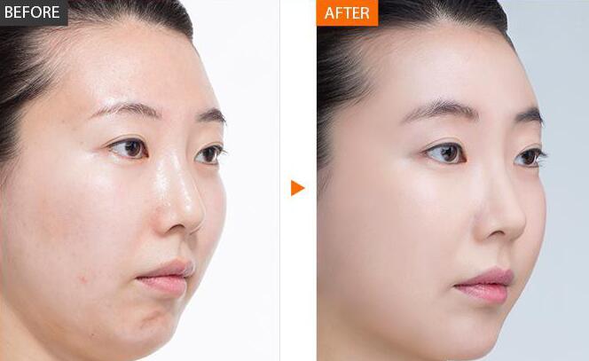 光子嫩膚*果能維持多久、全身光子嫩膚多少錢？