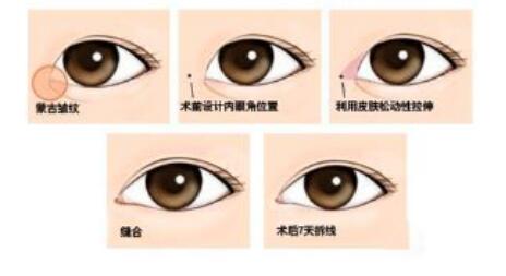 韓式開(kāi)眼角手術(shù)*果怎么樣？開(kāi)眼角前后照