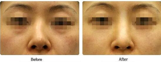 歪鼻矯正風(fēng)險大嗎、歪鼻矯正手術(shù)多少錢