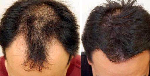 調(diào)節(jié)脫發(fā)多少費(fèi)用？上海調(diào)節(jié)脫發(fā)要多少錢(qián)？