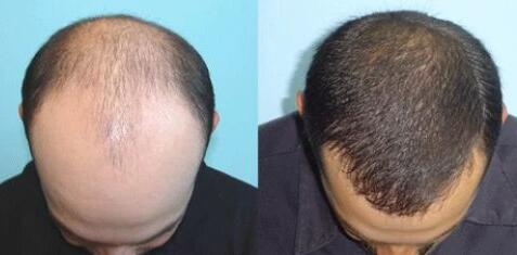 調(diào)節(jié)脫發(fā)多少費(fèi)用？上海調(diào)節(jié)脫發(fā)要多少錢(qián)？